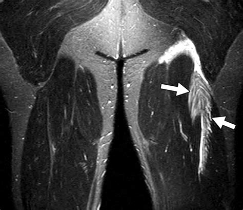 thomas test hamstring tear|mri for hamstring injury.